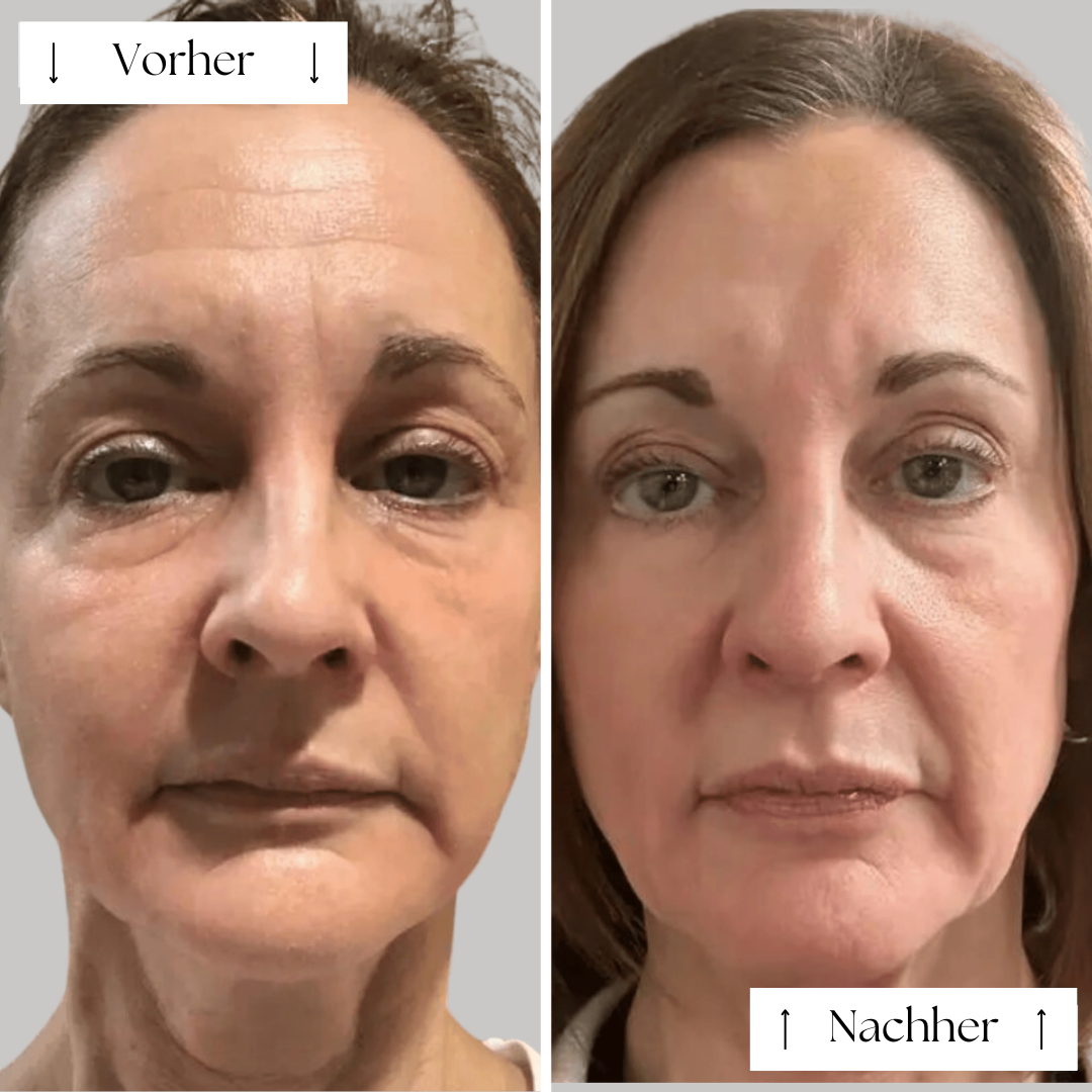 FVRLLY LED-Beauty-Maske | Rotlicht Gesichtsmaske