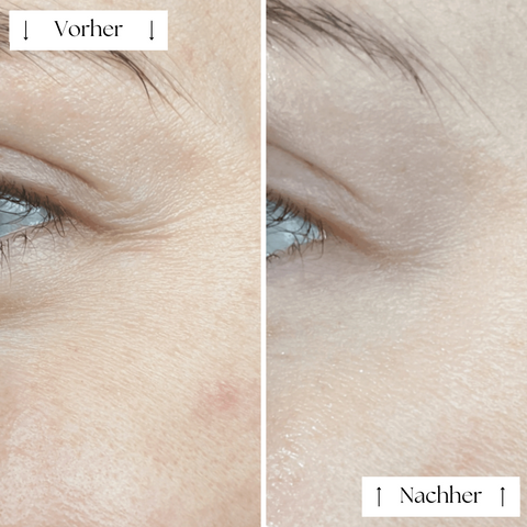 FVRLLY LED-Kontur-Maske | In 30 Tagen Zur Perfekten Haut