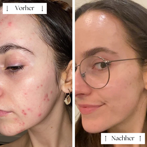 FVRLLY LED-Kontur-Maske | In 30 Tagen Zur Perfekten Haut