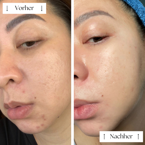 FVRLLY LED-Kontur-Maske | In 30 Tagen Zur Perfekten Haut