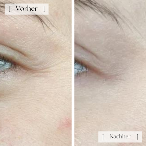 FVRLLY LED-Kontur-Maske | In 30 Tagen Zur Perfekten Haut
