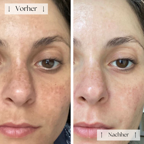 FVRLLY LED-Kontur-Maske | In 30 Tagen Zur Perfekten Haut