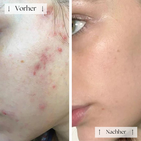 FVRLLY LED-Kontur-Maske | In 30 Tagen Zur Perfekten Haut
