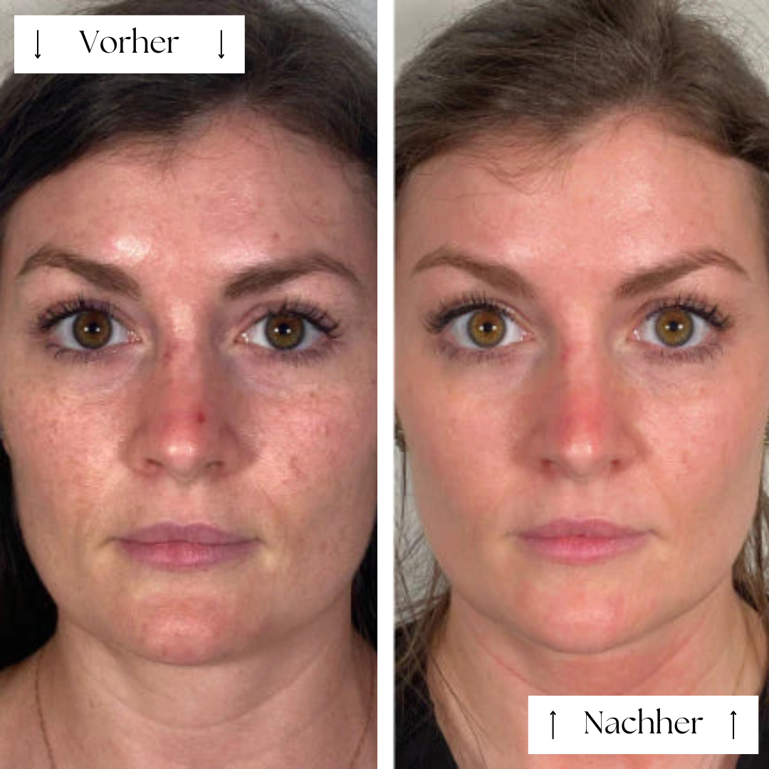 FVRLLY LED-Beauty-Maske | Rotlicht Gesichtsmaske
